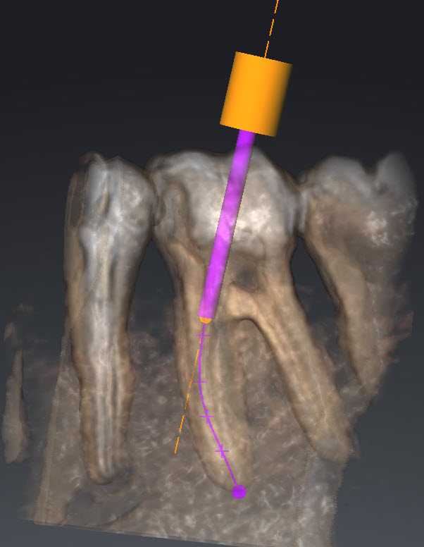 Endo Analysis 3 Teeth